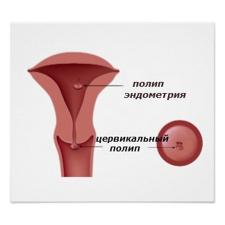 Полипы эндометрия, шейки матки и цервикального канала