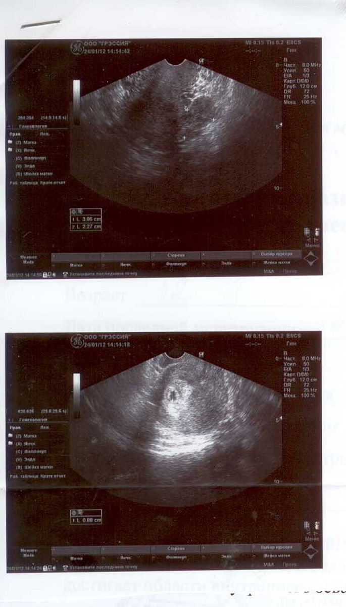 15 3 недели беременности