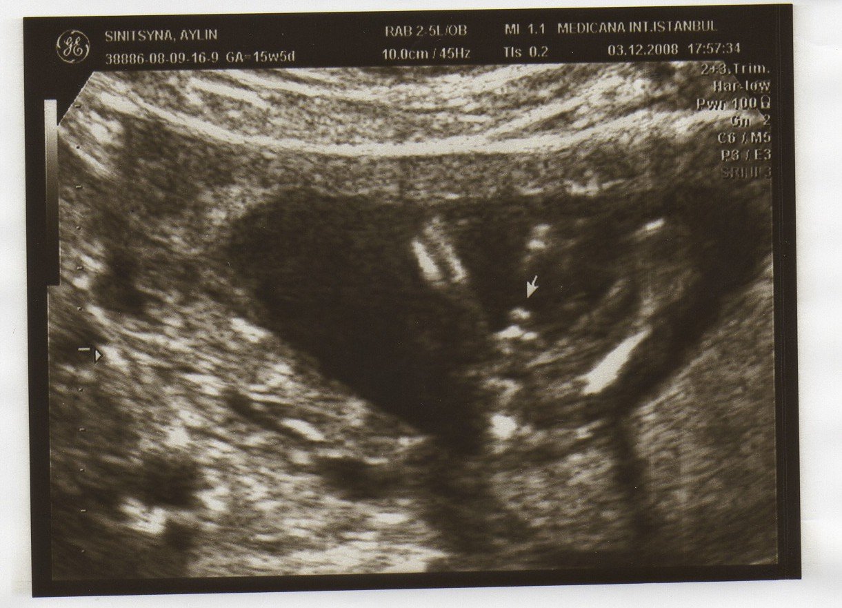 16 недель 3 5. УЗИ 16 недель беременности мальчик. УЗИ 16 недель беременности фото.