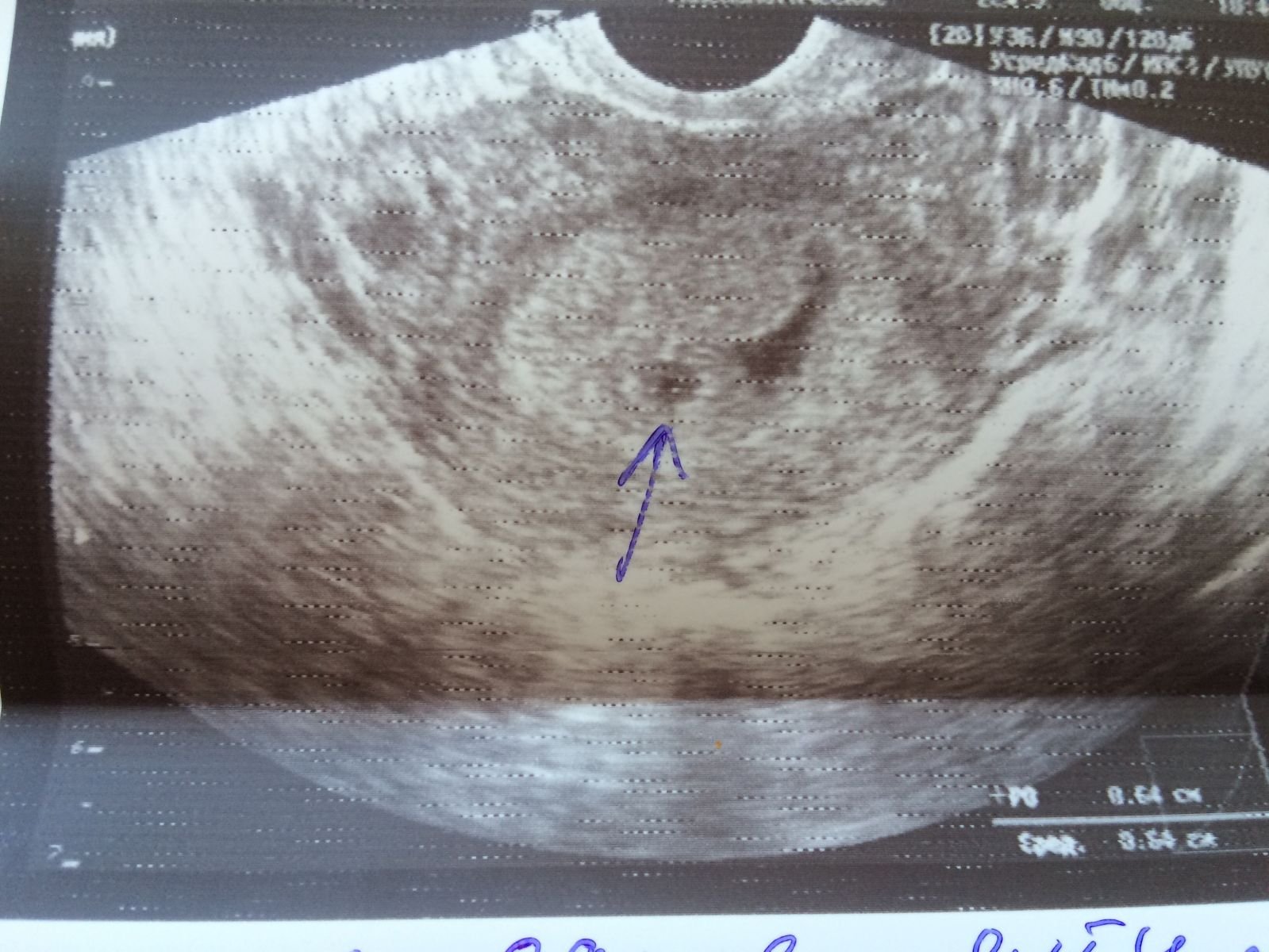 На 3 неделе тянет. Эмбрион 2-3 недели УЗИ беременности. УЗИ беременности 2.5 недели. УЗИ плодное яйцо 2 недели. Беременность на 2-3 недели беременности на УЗИ.