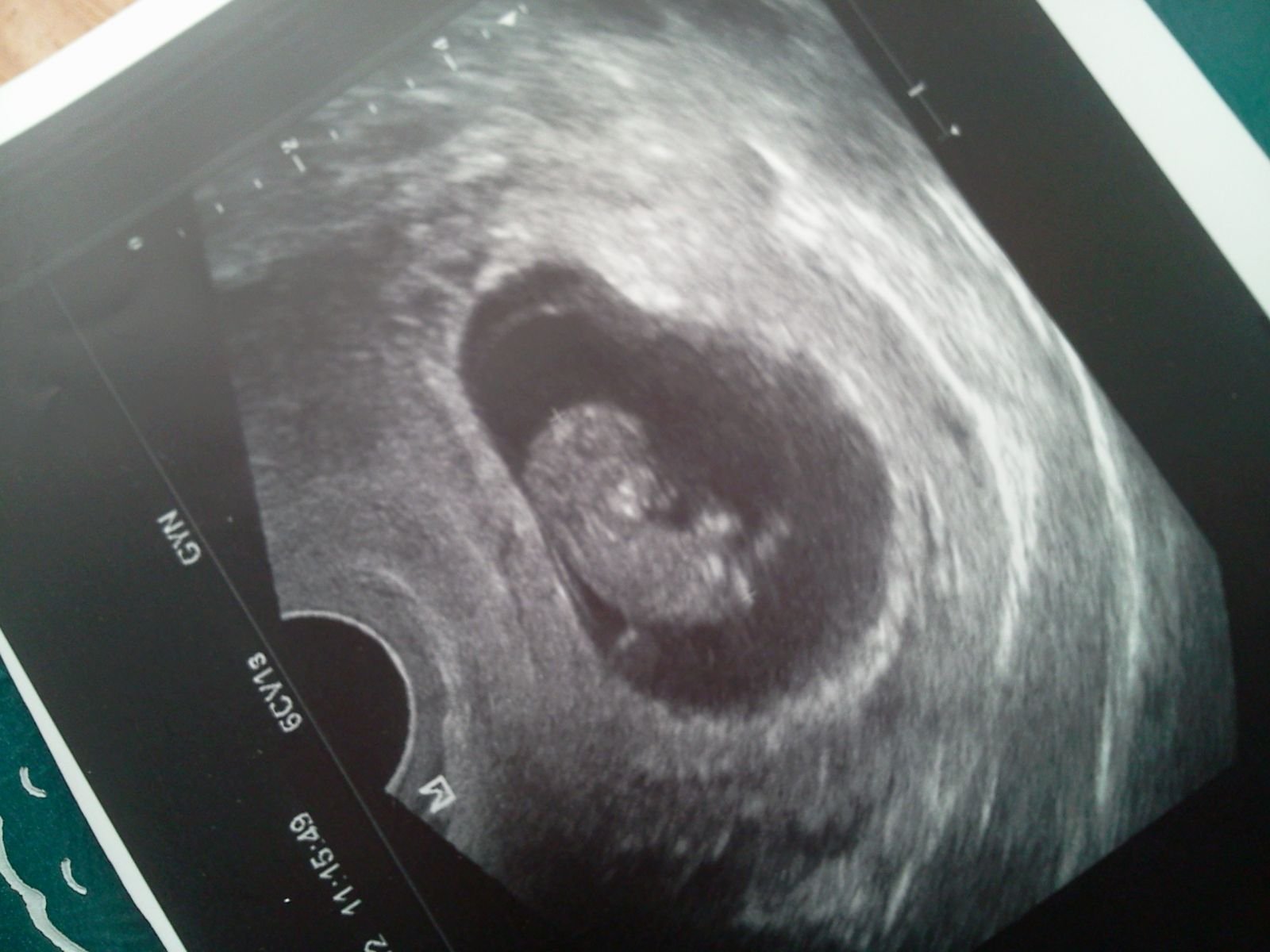 Беременность 5 недель фото. Плод на 2 месяце беременности УЗИ. Снимок УЗИ на 2 месяце беременности. Эмбрион на 2 месяце беременности. Плод в 3 недели беременности на УЗИ.