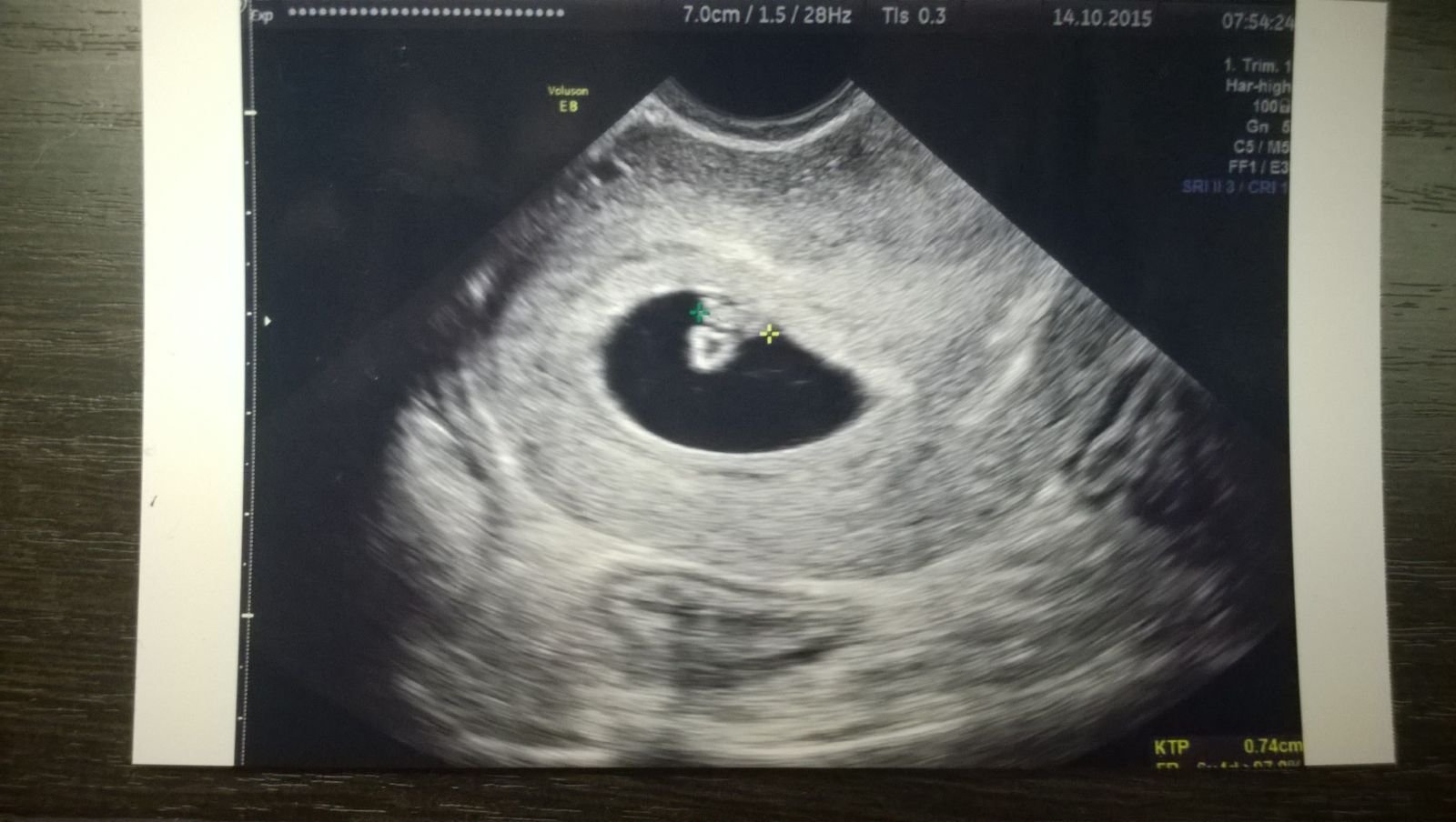 Как выглядит узи на 6 неделе. Эмбрион 5 6 недель беременности УЗИ. Эмбрион на 6 неделе беременности УЗИ. Плодное яйцо на 6 неделе беременности УЗИ. УЗИ плода на 5-6 неделе беременности.
