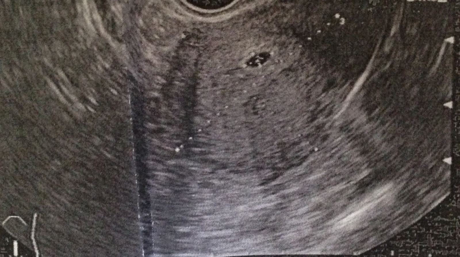 Узи срок 3 недели. УЗИ 2-3 недели беременности. УЗИ 2 недели беременности. Снимок УЗИ на 3 неделе беременности. УЗИ 4 недели беременности.