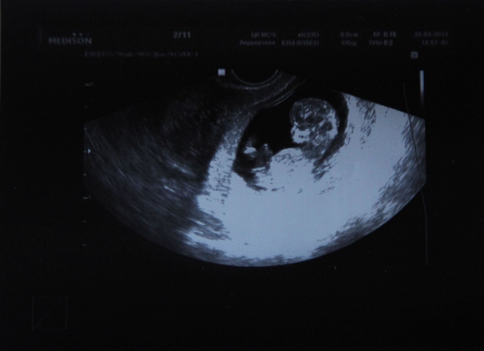 На 11 неделе тянет. УЗИ 10-11 недель беременности. УЗИ 11 недель беременности. 11 И 5 недель беременности УЗИ. Фото УЗИ беременности 11 недель беременности.