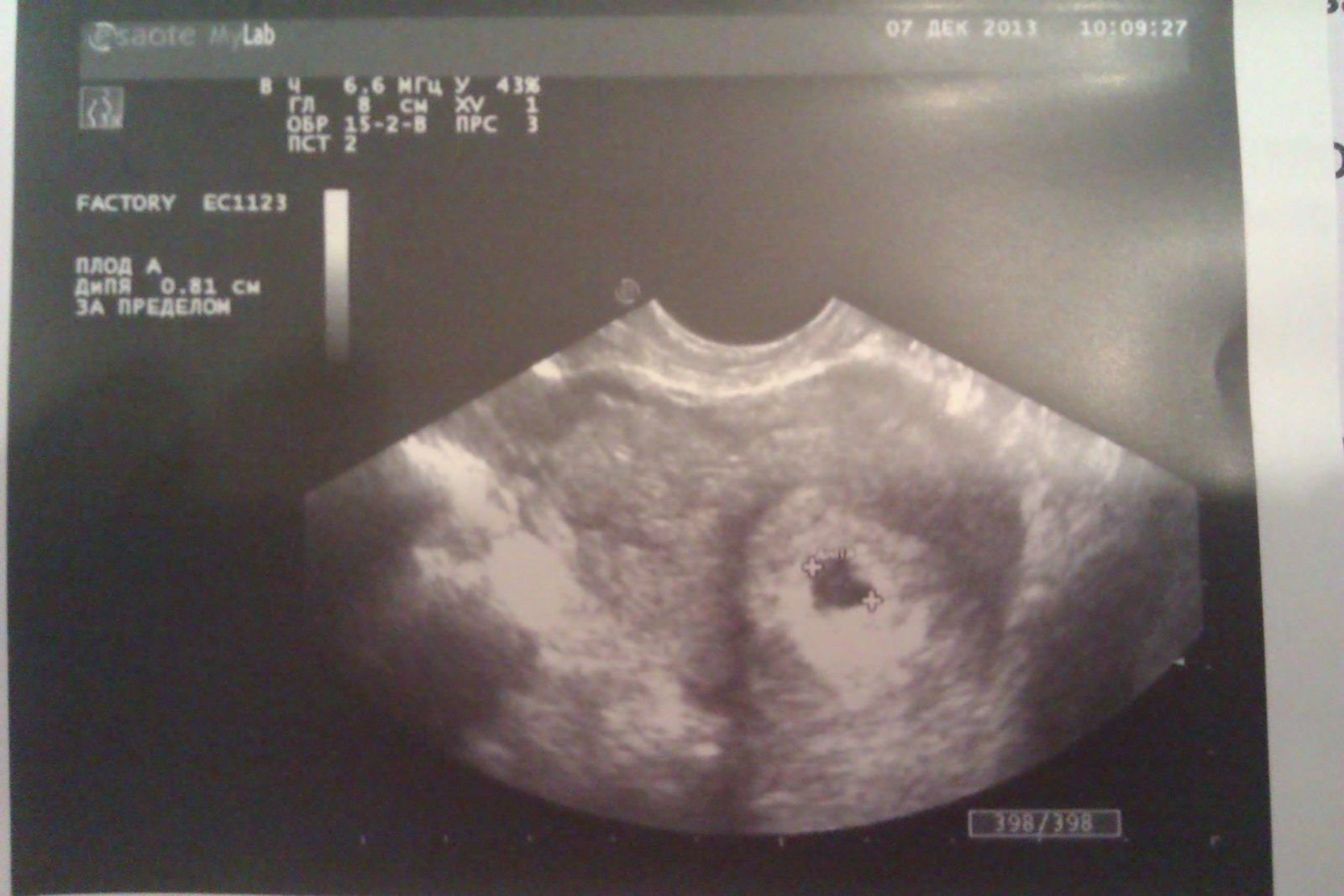 Узи 3 4 недели. Снимок УЗИ беременности 3-4 недели. УЗИ 3-4 недели беременности. УЗИ 4 недели беременности.