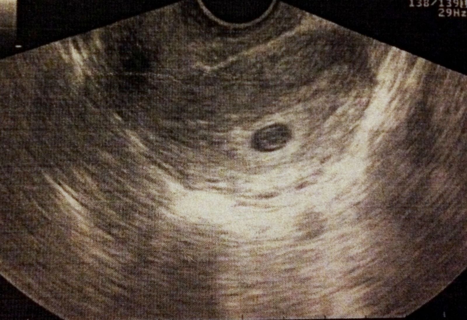 Через четыре недели. УЗИ 4 5 недель беременности УЗИ. Снимок УЗИ на 5 неделе беременности. Плод на 5 неделе беременности УЗИ. УЗИ беременной на 5 неделе беременности.