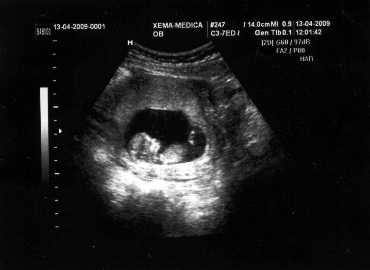 Наш маленький человечек! :-) Малышу 10 недель 3дня, беременность 12 н 3 д.