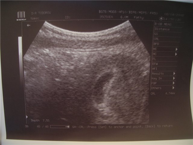 Нам 6 недель и 4 дня(акушерских)!!!Эмбриончик 4.7мм и наше сердечко уже бьется!!!