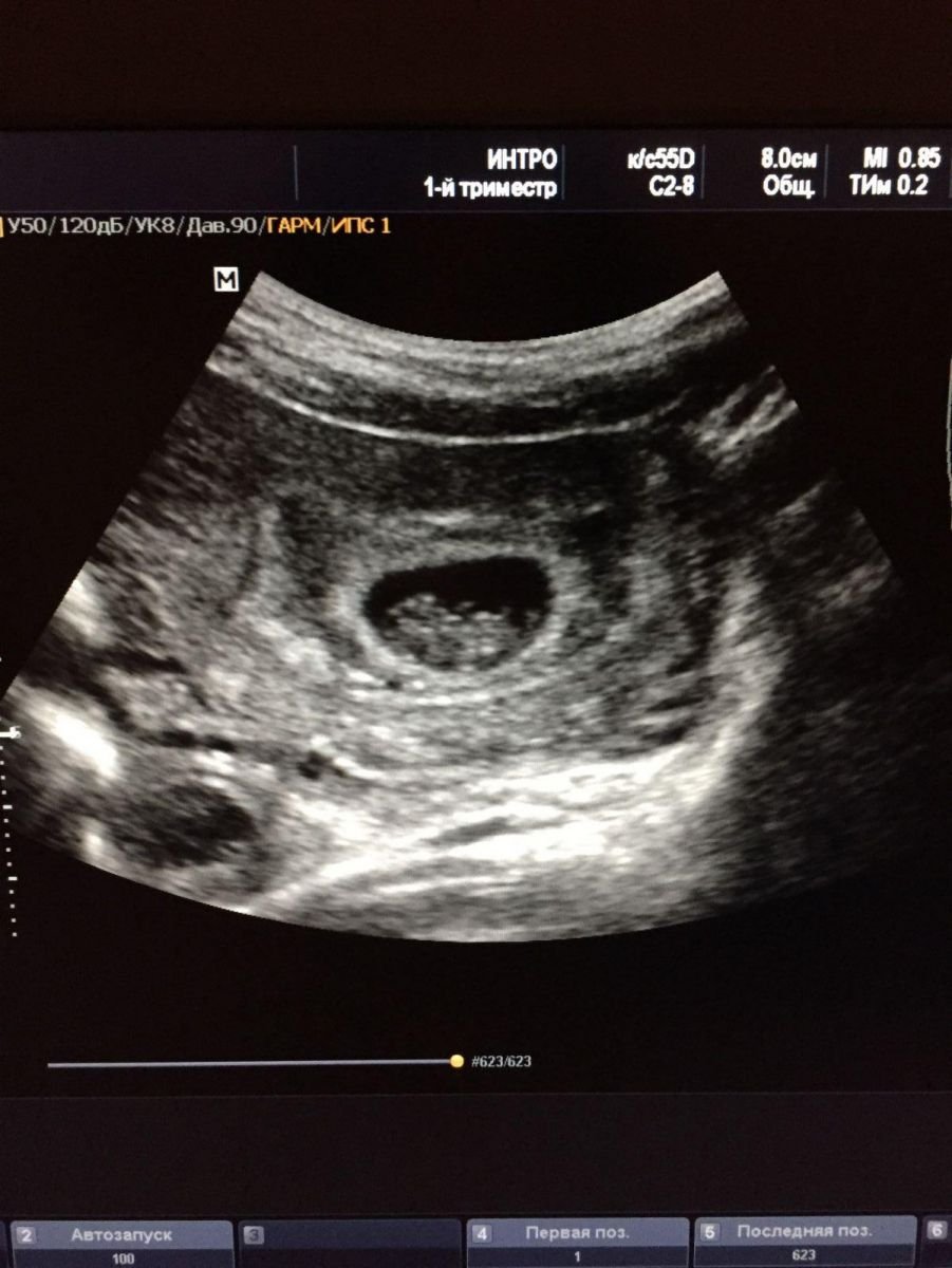 Узи плода 8 неделе. Как выглядит эмбрион в 8 недель на УЗИ. УЗИ на 8 неделе беременности акушерской. УЗИ 8 недель беременности УЗИ. УЗИ беременности 8 недель беременности.