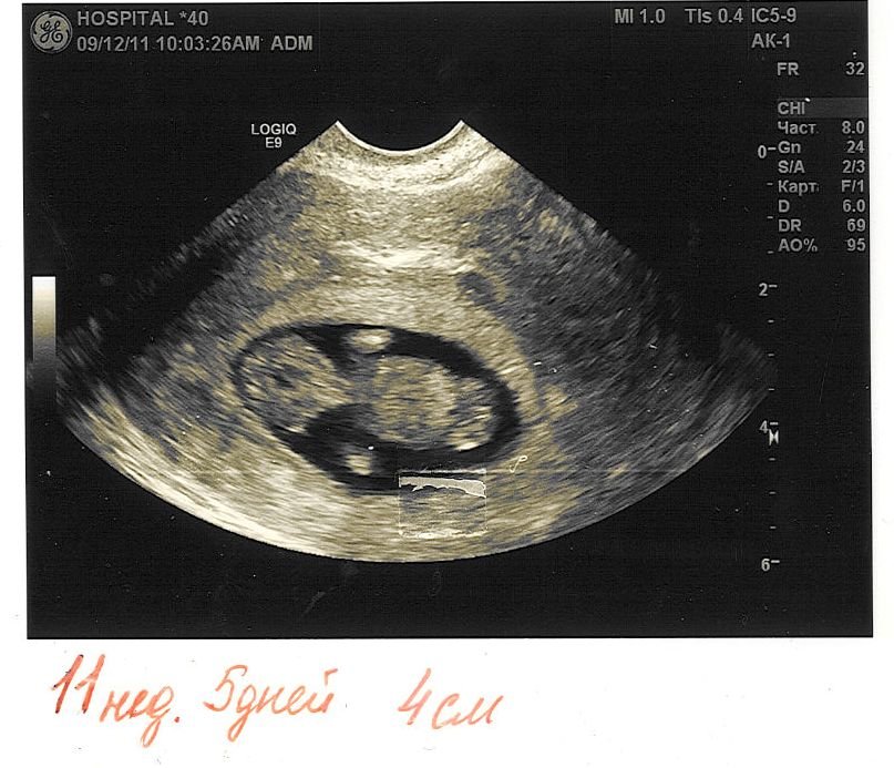 Плод 11 недель фото. УЗИ 11 недель беременности. УЗИ 10-11 недель беременности.
