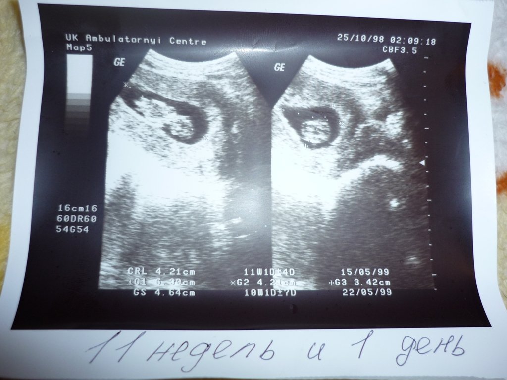 11 неделя 3 дня. УЗИ 10-11 недель беременности. УЗИ 11 недель беременности описание. УЗИ 11 недель беременности. Снимок УЗИ беременности 11-12 недель.