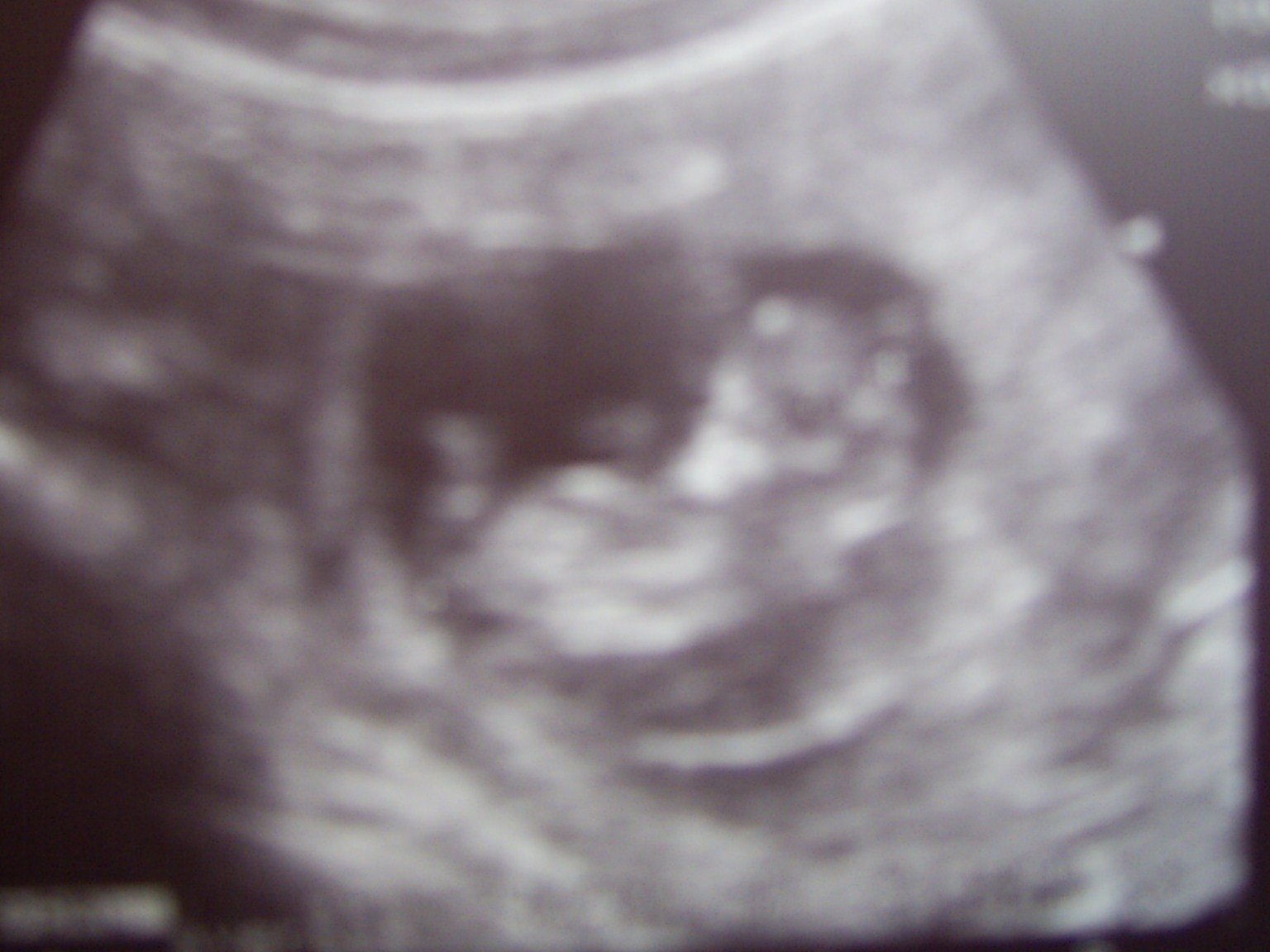 Плод 11 недель фото. Плод на 11 неделе беременности. Ребёнок на 11 неделе беременности. УЗИ 11 недель беременности.