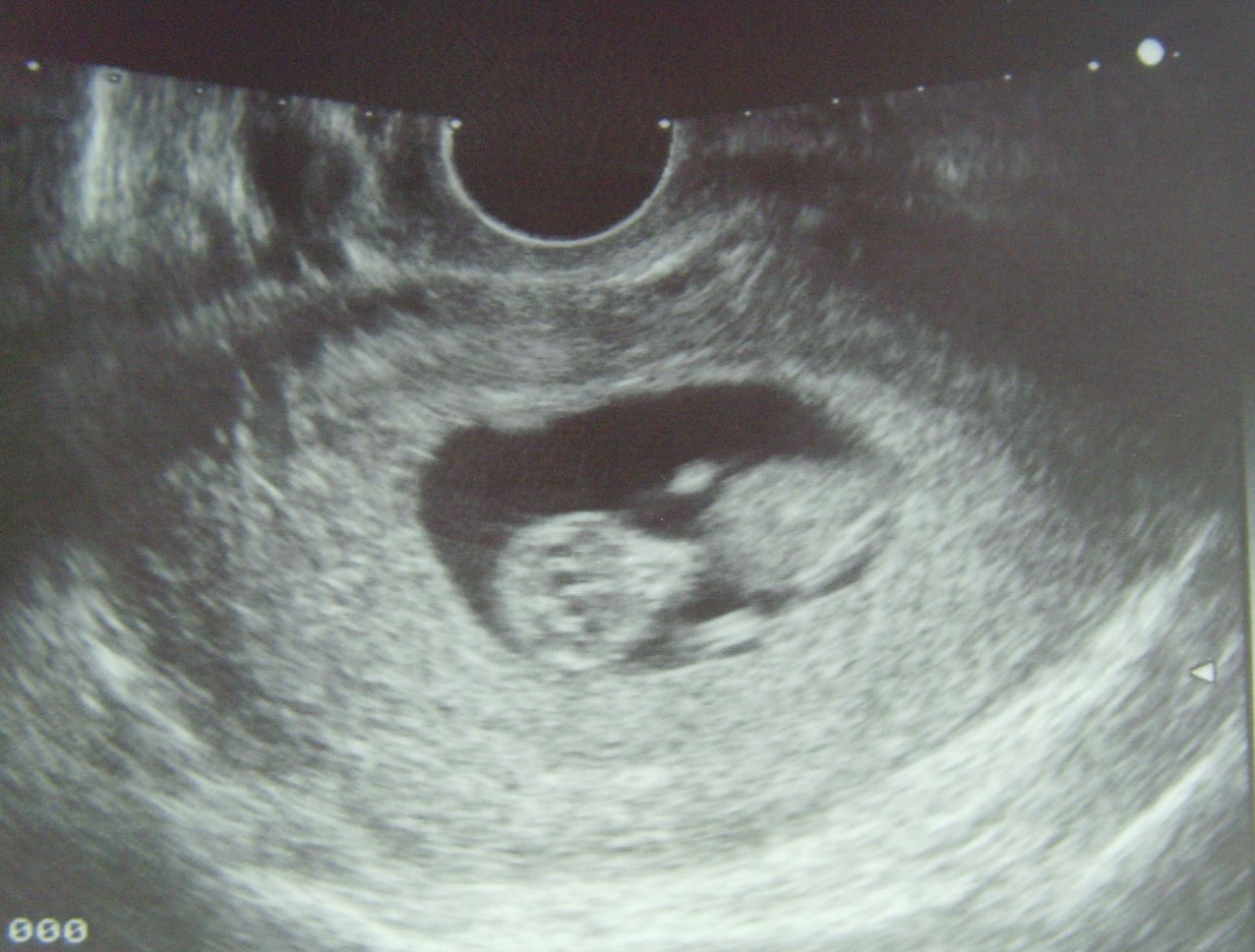 Видео 10 недели. УЗИ на 11 неделе беременности на УЗИ. УЗИ плода на 11 неделе беременности. УЗИ 11 недель беременности. 11 Нед беременности на УЗИ.