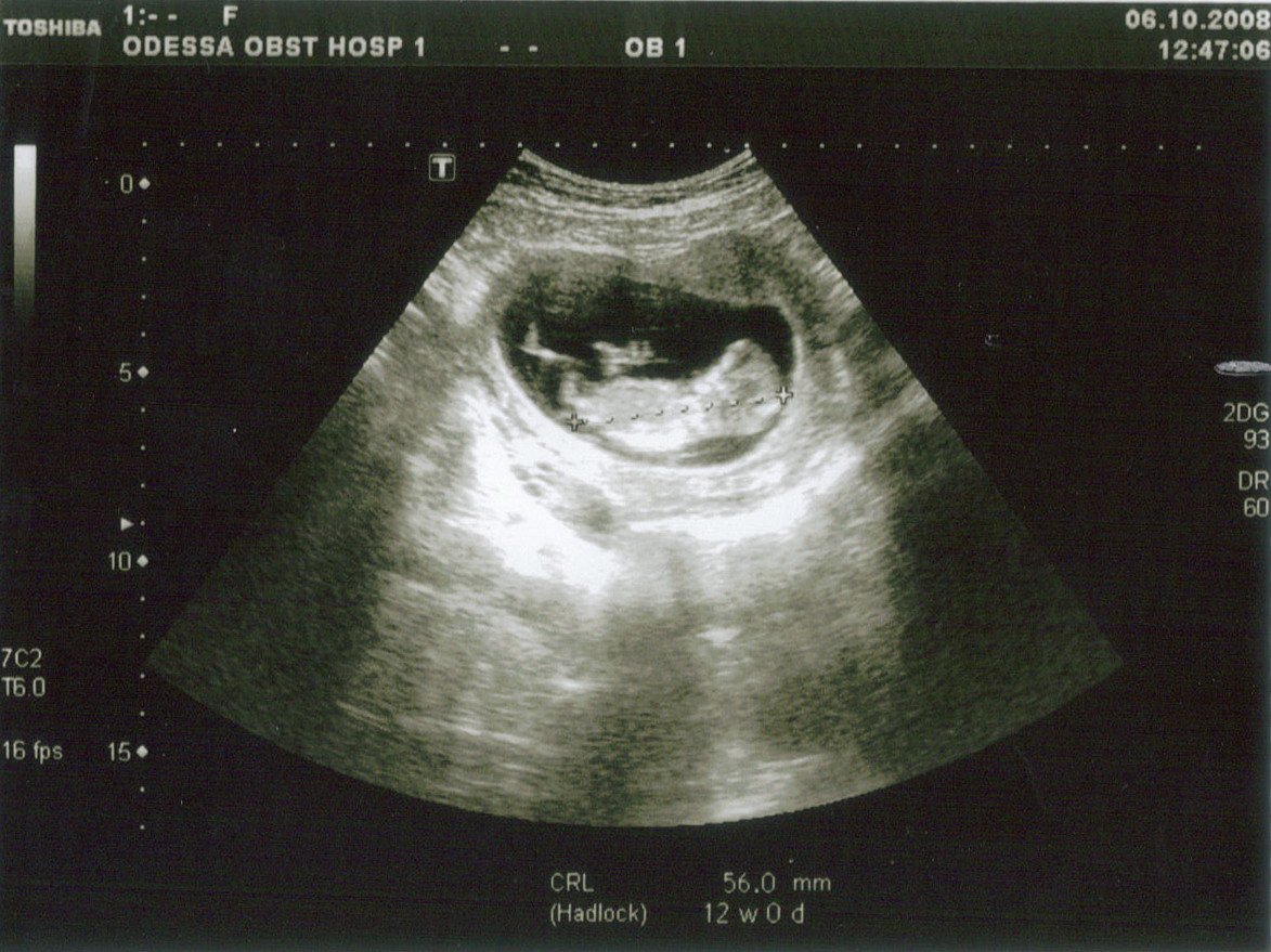 Ребенок 11 недель узи. УЗИ 11 недель беременности. 11 Недель беременности фото плода на УЗИ. 10-11 Недель беременности фото плода на УЗИ. Фото эмбриона на 11 неделе беременности на УЗИ.