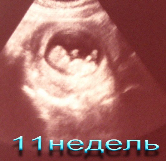 10 неделя 2024г. УЗИ 11 недель беременности. УЗИ 10-11 недель беременности.