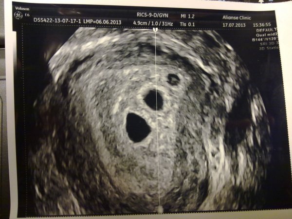 УЗИ многоплодная беременность, 6 недель (3,5 от зачатия)