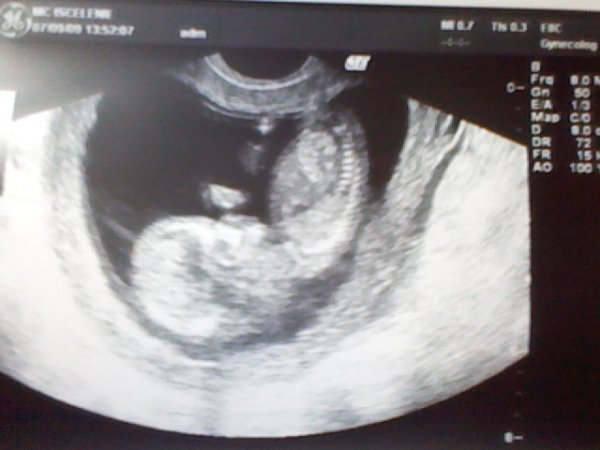 Малышу 10,5 недель от зачатия. Сидит в позе лотоса.