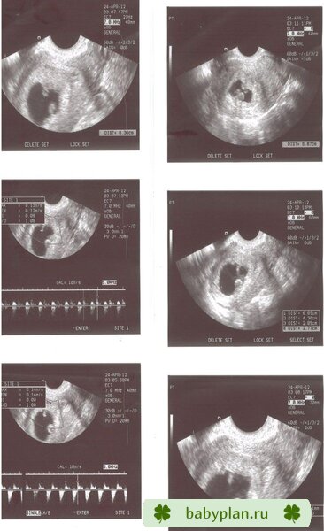 6недель - двойня?