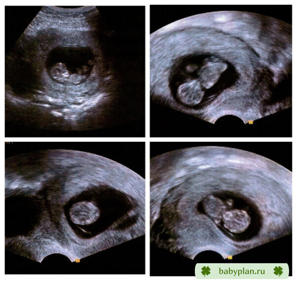 Второе узи плода