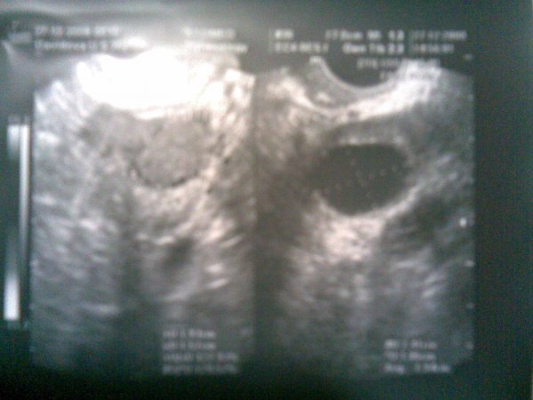 На фото слева-правый яичник с жёлтым телом, справа-левый яичник с кистой.