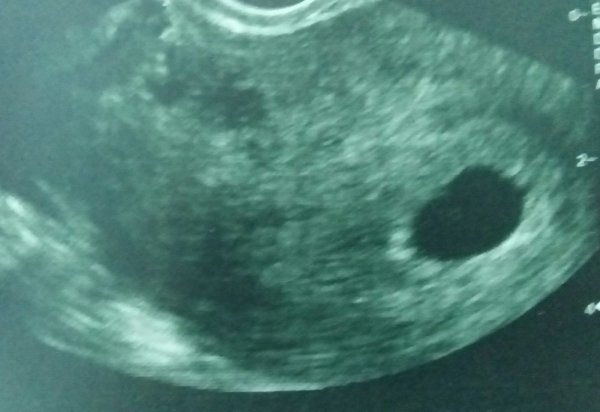 Анэмбриония? Беременность 5 недель и 6 дней.