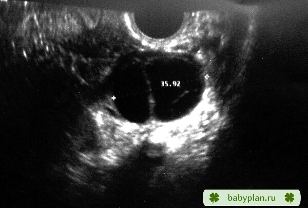 двухкамерная киста или 2 кисты желтого тела?