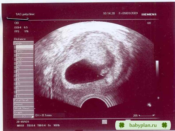 наш малыш, 5 нед от зачатия, 8 мм