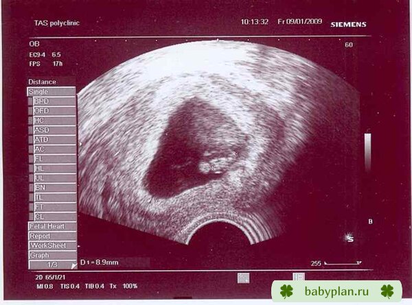 наш малыш, 5 нед от зачатия, 8 мм