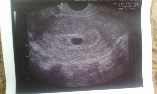 6 недель от посл. мес (1 марта) эмбрион четко не визуализируется