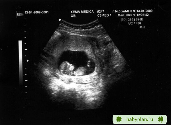 Наш маленький человечек! :-) Малышу 10 недель 3дня, беременность 12 н 3 д.