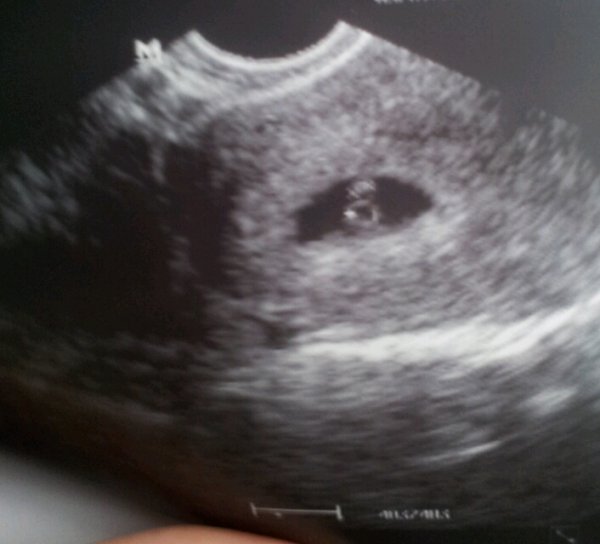 Наш эмбриончик 6 нед. 2 дня