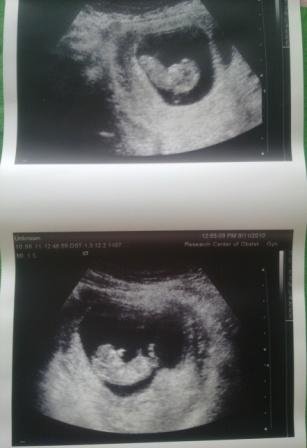 Мои двойняшки 11 недель 4-5 дней