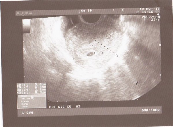 акушерские 5 недель и 3 дня. эмбриональных ровно 3 недели.