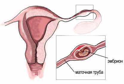 Внематочная трубная беременность