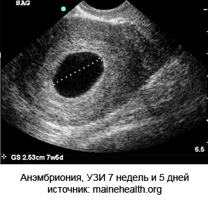 Анэмбриония на УЗИ