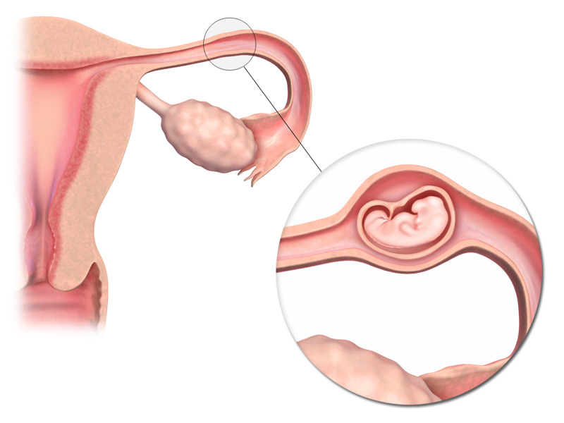 как забеременеть после внематочной