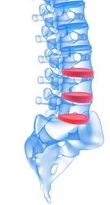 Остеохондроз поясничного отдела позвоночника и роды