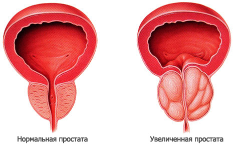 Простатит