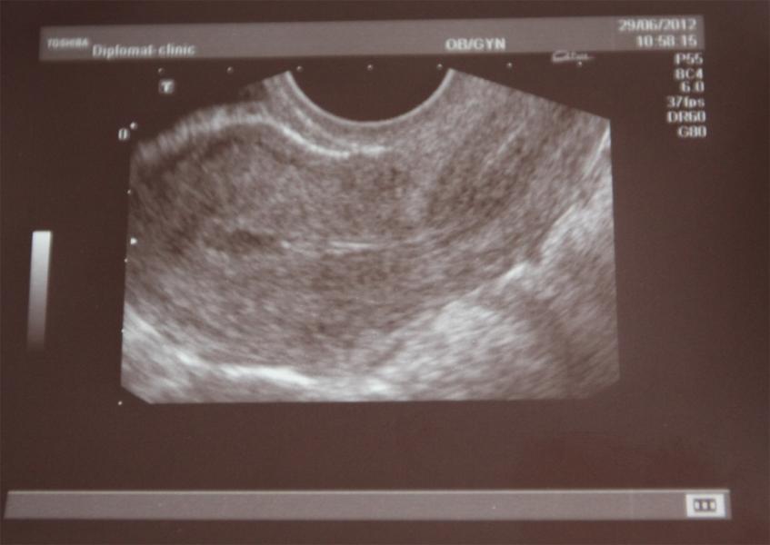 Эндометрий 4 2. Маточная беременность УЗИ.
