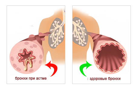 Бронхиальная астма как противопоказание к беременности thumbnail