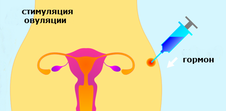 стимуляция овуляции при ЭКО