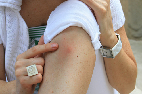 Аллергия на комариные укусы при беременности thumbnail