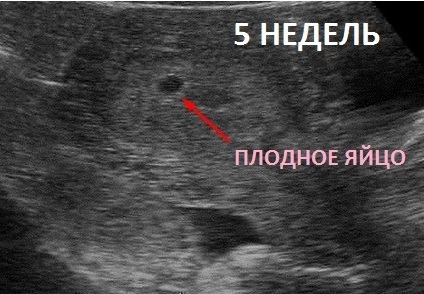 Фото Узи На Сроке 6 Недель