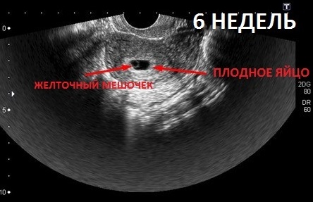 Фото Узи На Сроке 6 Недель