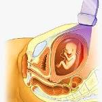 Небольшая гематома при беременности на ранних сроках thumbnail