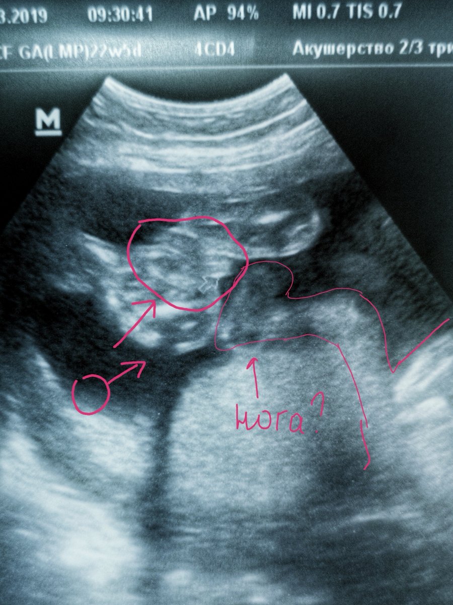 Фото Узи 25 Недель Беременности Мальчик