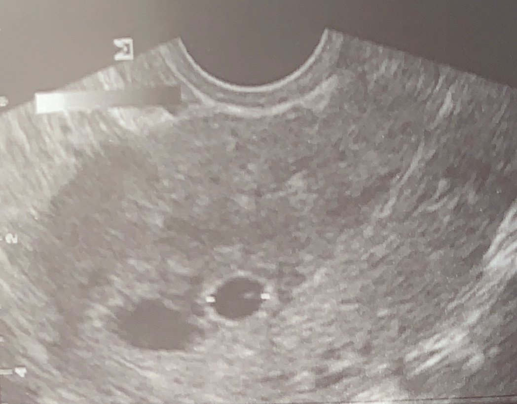 Отслойка на 6 неделе. УЗИ В 5-6 недель беременности гематома. УЗИ 6 недель беременности отслойка плодного яйца. Отслойка плодного яйца на 5 неделе. Ретрохориальная гематома.