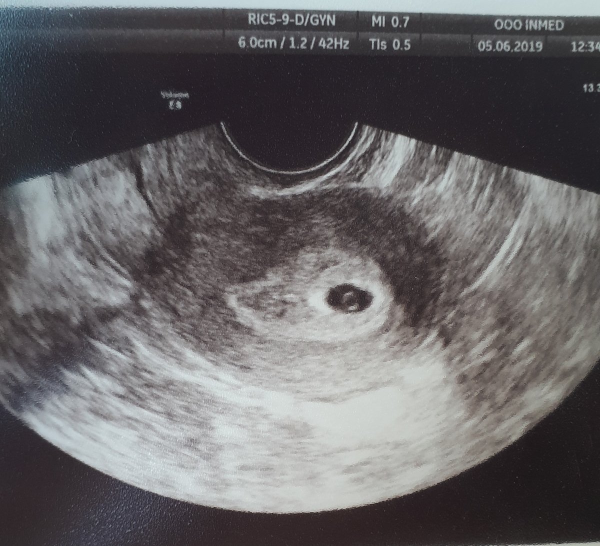 Узи 3 4 недели. Снимок УЗИ беременности 3 неделя беременности. УЗИ на ранних сроках беременности 5 недель. УЗИ на 5 неделе беременности. УЗИ 1-2 недели беременности.