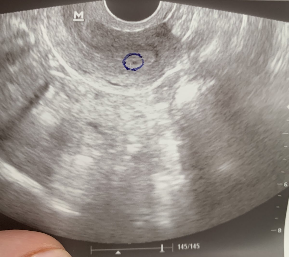 Эндометрия 3 мм. УЗИ плодного яйца на 5 неделе беременности.