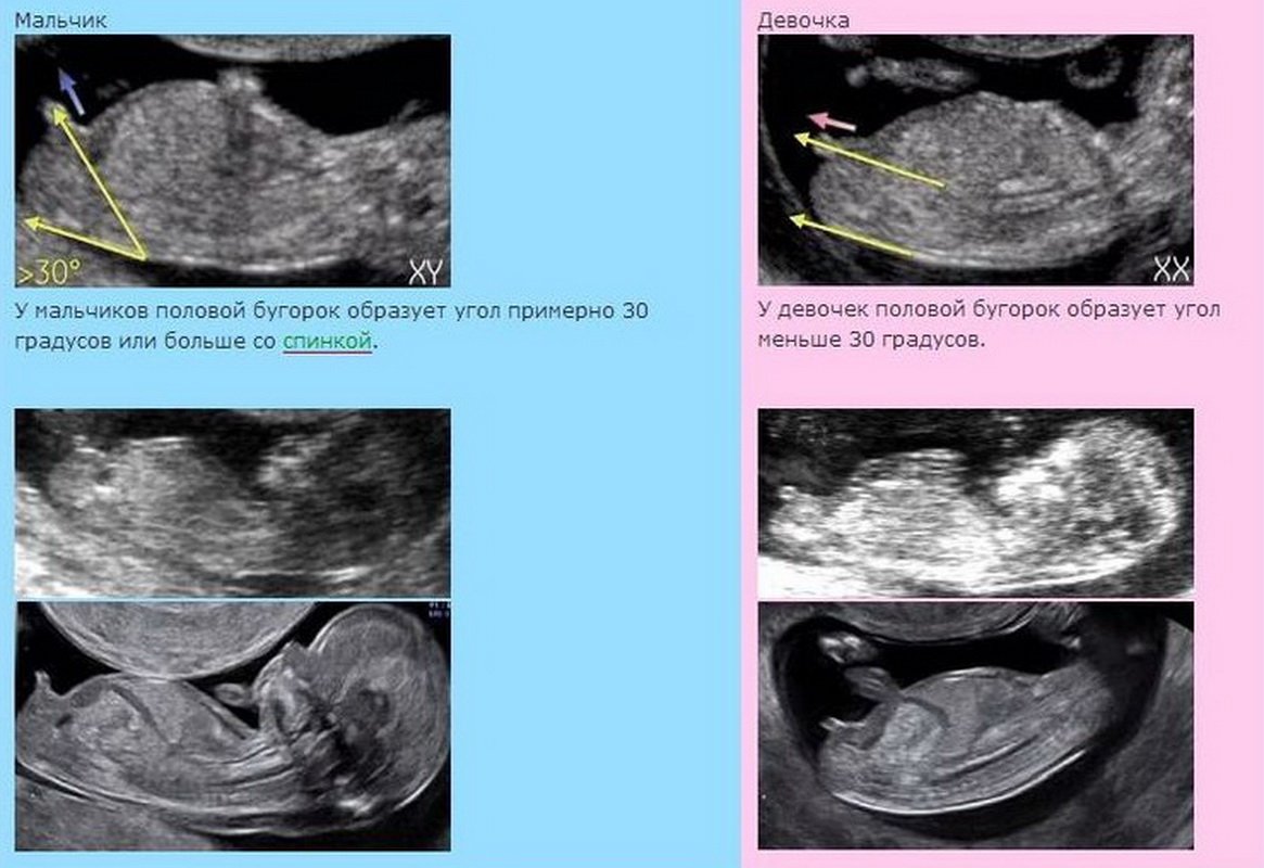 12 неделя беременности определить пол ребенка